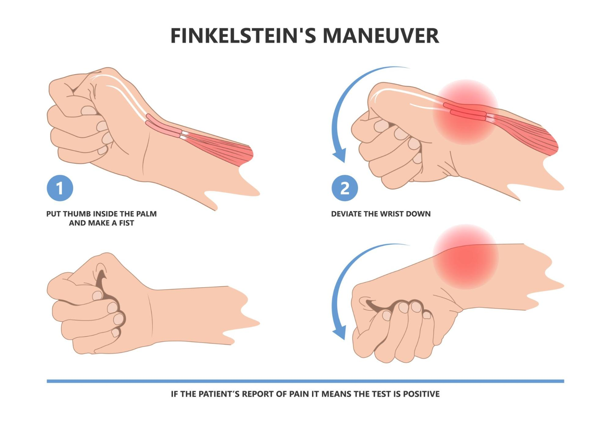 Finkelstein’s maneuver